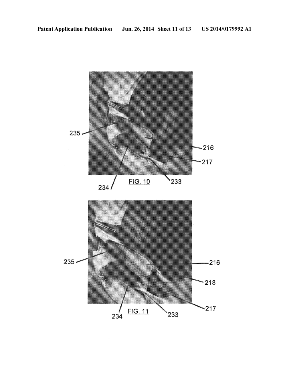 Apparatus For Treating Vaginal Prolapse - diagram, schematic, and image 12