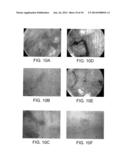 SYSTEM FOR DISTENDING BODY TISSUE CAVITIES BY CONTINUOUS FLOW IRRIGATION diagram and image