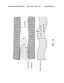 Renal Injury Inhibiting Devices, Systems, and Methods Employing     Low-Frequency Ultrasound or Other Cyclical Pressure Energies diagram and image