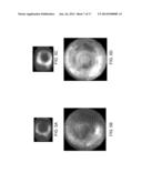 Renal Injury Inhibiting Devices, Systems, and Methods Employing     Low-Frequency Ultrasound or Other Cyclical Pressure Energies diagram and image