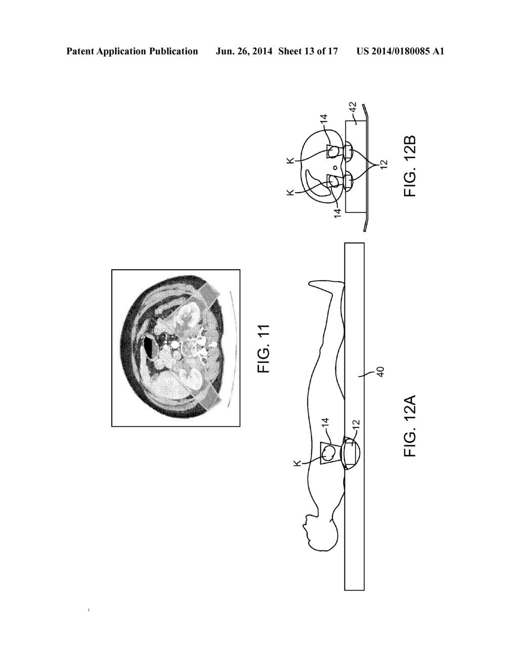 Renal Injury Inhibiting Devices, Systems, and Methods Employing     Low-Frequency Ultrasound or Other Cyclical Pressure Energies - diagram, schematic, and image 14