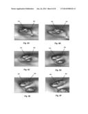 Ultrasound Imaging Catheters with Reciprocating Phased Array Transducers diagram and image