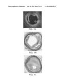 TUNED RF ENERGY AND ELECTRICAL TISSUE CHARACTERIZATION FOR SELECTIVE     TREATMENT OF TARGET TISSUES diagram and image