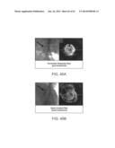 TUNED RF ENERGY AND ELECTRICAL TISSUE CHARACTERIZATION FOR SELECTIVE     TREATMENT OF TARGET TISSUES diagram and image