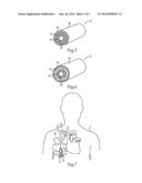Catheter Assembly With Cuff Deployment Device diagram and image
