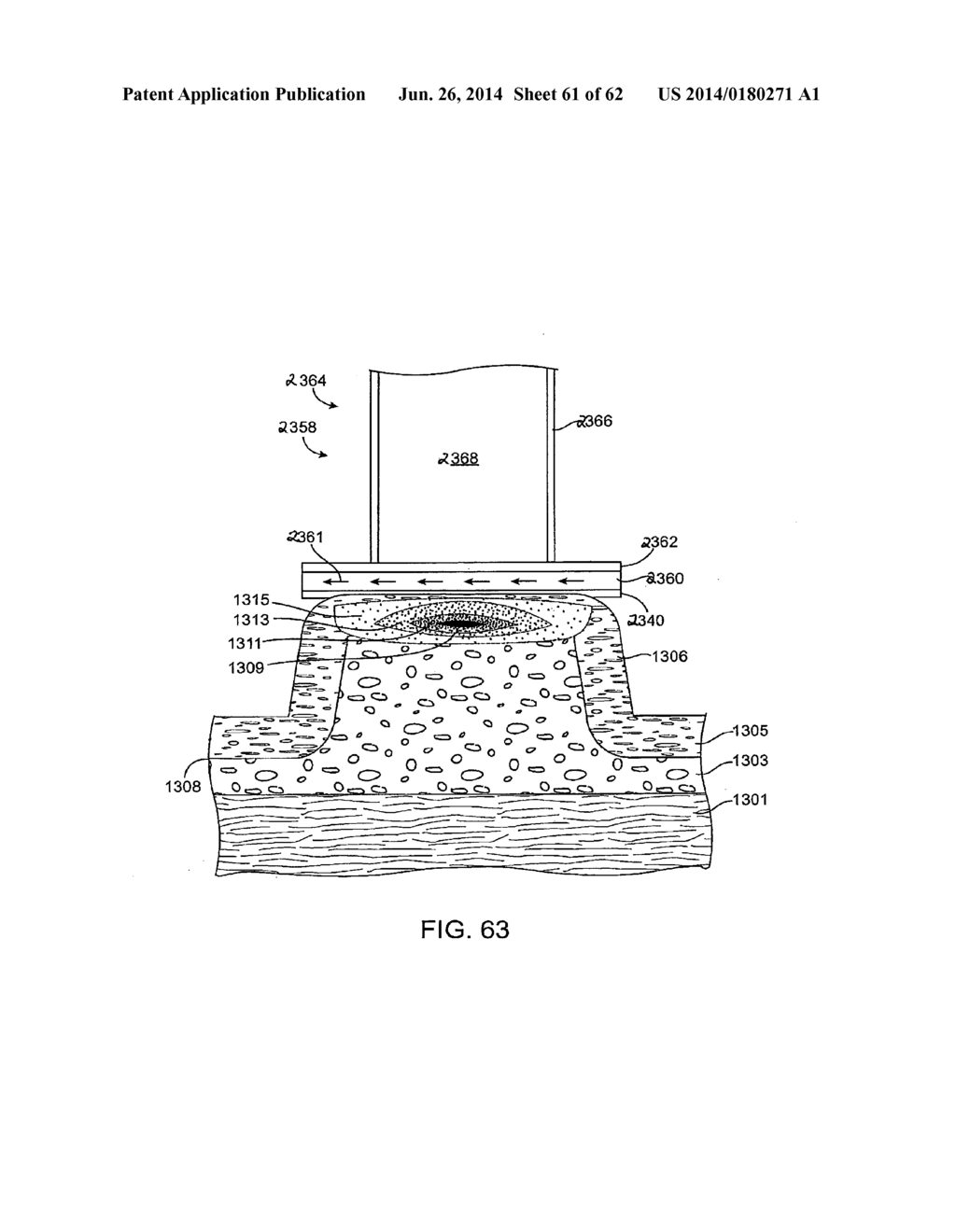 SYSTEMS, APPARATUS, METHODS AND PROCEDURES FOR THE NON-INVASIVE TREATMENT     OF TISSUE USING MICROWAVE ENERGY - diagram, schematic, and image 62