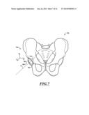 DEVICES AND METHODS FOR HIP REPLACEMENT diagram and image