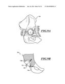 DEVICES AND METHODS FOR HIP REPLACEMENT diagram and image