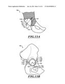 DEVICES AND METHODS FOR HIP REPLACEMENT diagram and image