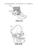 DEVICES AND METHODS FOR HIP REPLACEMENT diagram and image