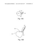 ARTICULATING SUTURING DEVICE diagram and image