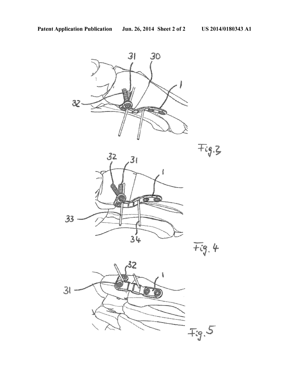 Anatomically Customized Plantar Bone Plate and Bone Plate System - diagram, schematic, and image 03