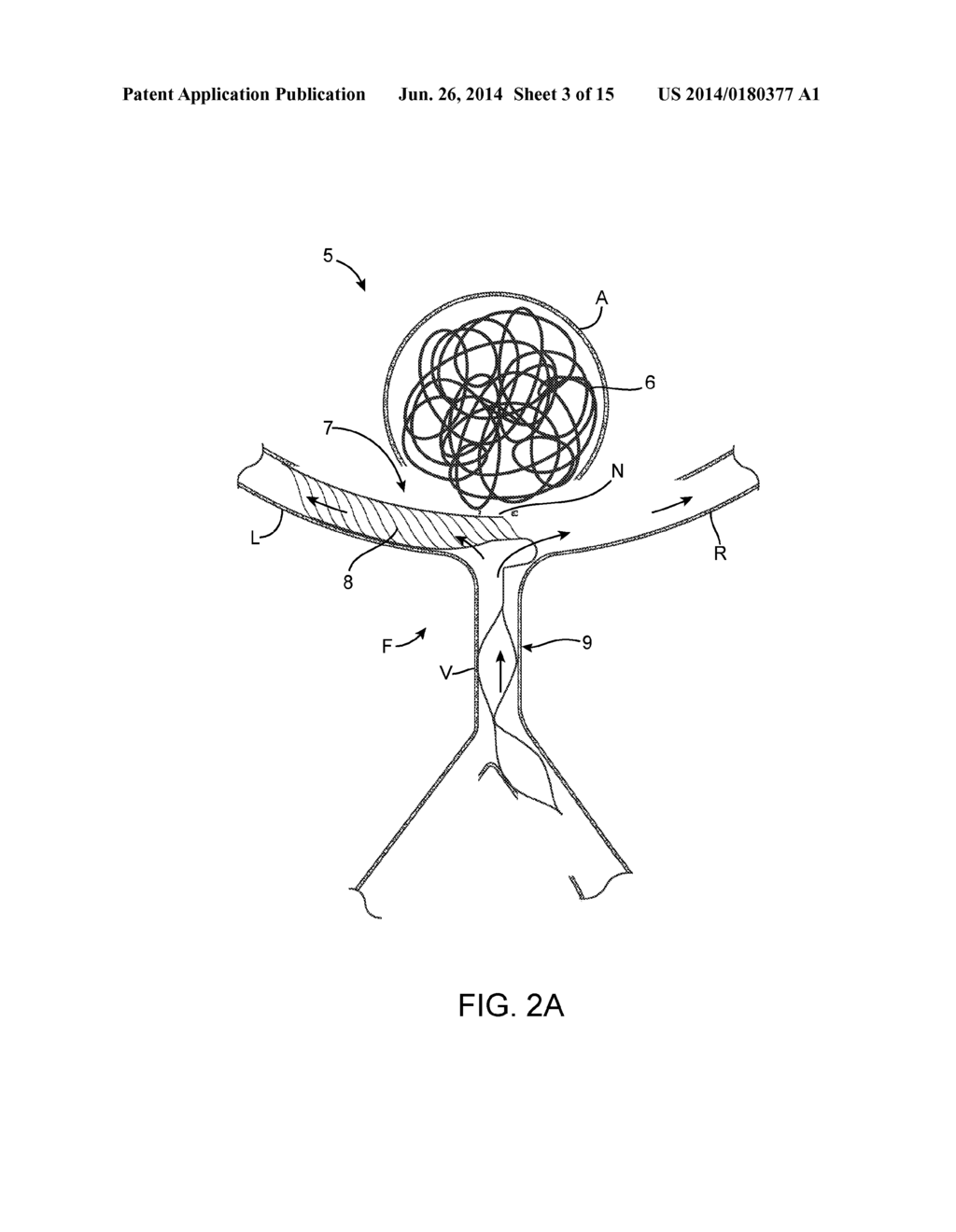 ANEURYSM OCCLUSION SYSTEM AND METHOD - diagram, schematic, and image 04