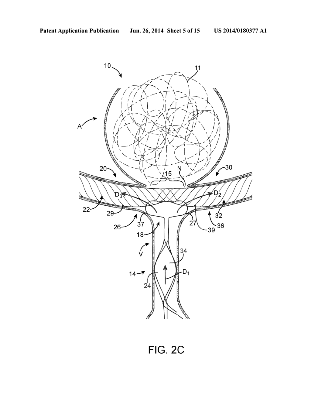 ANEURYSM OCCLUSION SYSTEM AND METHOD - diagram, schematic, and image 06