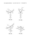 ANEURYSM OCCLUSION SYSTEM AND METHOD diagram and image