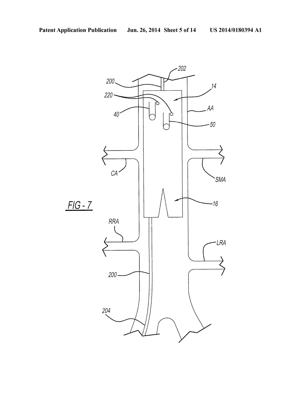 ENDOLUMINAL PROSTHESIS HAVING MODULAR BRANCHES AND METHODS OF DEPLOYMENT - diagram, schematic, and image 06