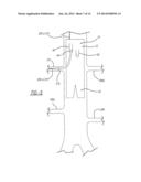 ENDOLUMINAL PROSTHESIS HAVING MODULAR BRANCHES AND METHODS OF DEPLOYMENT diagram and image