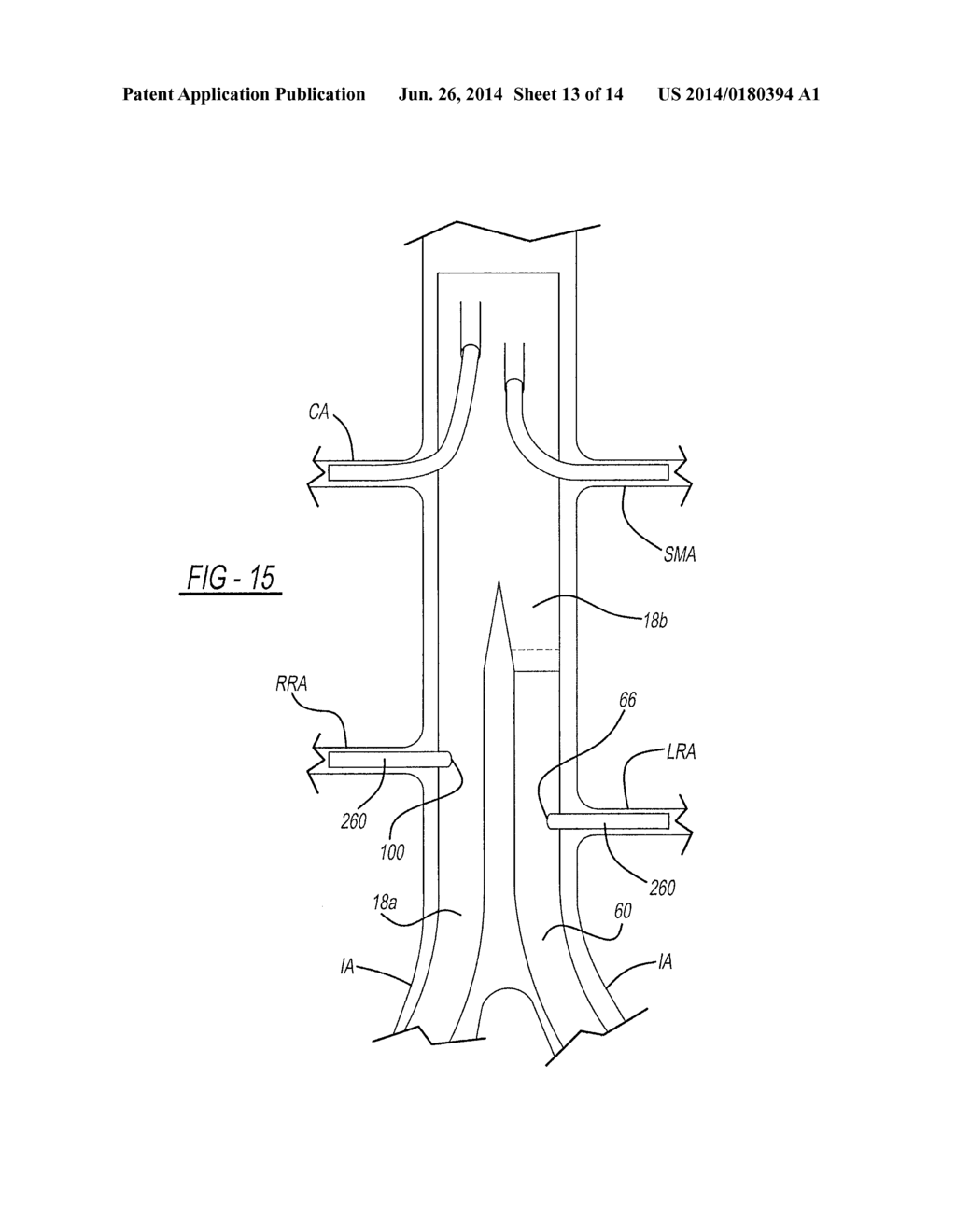 ENDOLUMINAL PROSTHESIS HAVING MODULAR BRANCHES AND METHODS OF DEPLOYMENT - diagram, schematic, and image 14