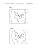 METHOD OF SELECTING A STENT BASED ON STRESS OF A BLOOD VESSEL diagram and image