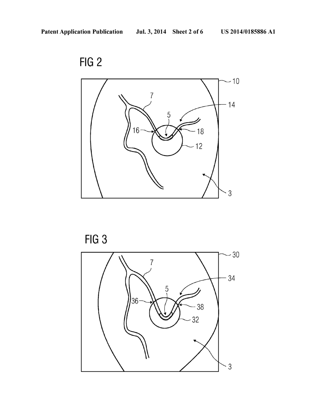 METHOD OF SELECTING A STENT BASED ON STRESS OF A BLOOD VESSEL - diagram, schematic, and image 03