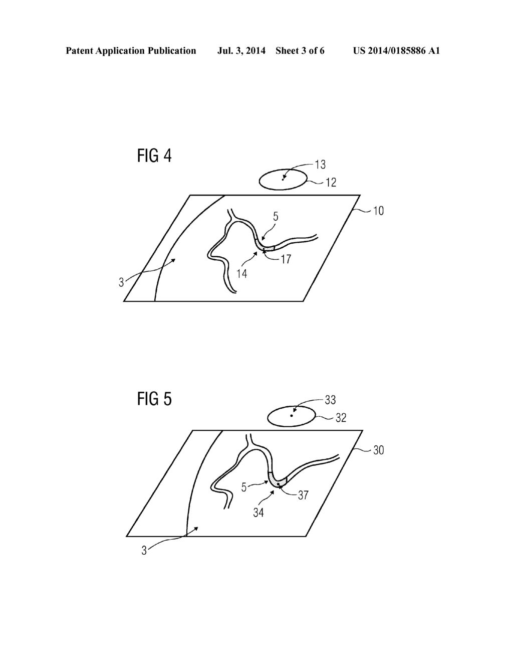 METHOD OF SELECTING A STENT BASED ON STRESS OF A BLOOD VESSEL - diagram, schematic, and image 04