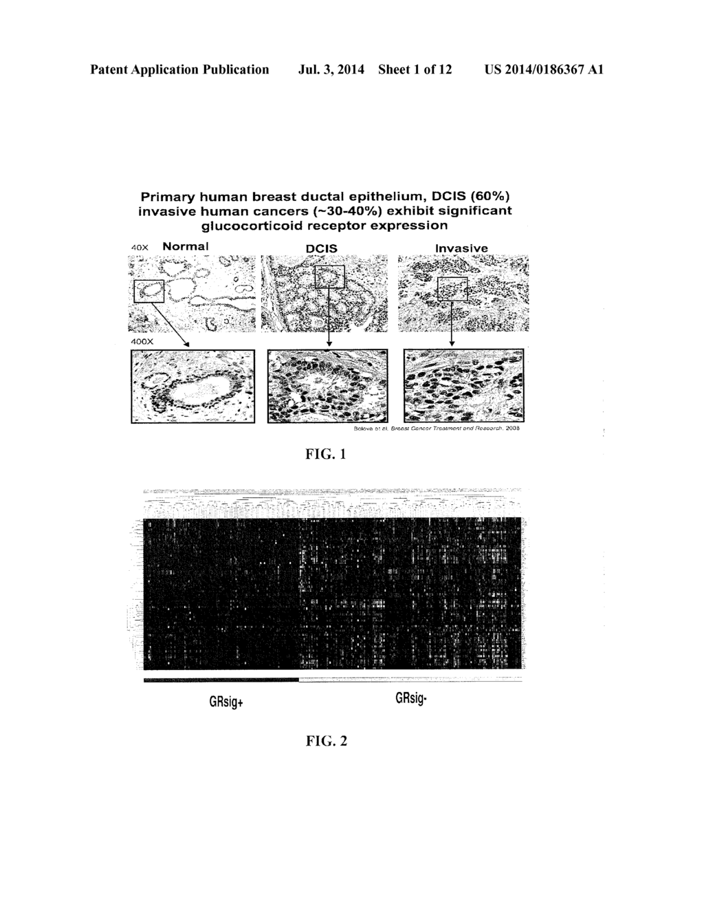 METHODS AND COMPOSITIONS RELATED TO GLUCOCORTICOID RECEPTOR ANTAGONISTS     AND BREAST CANCER - diagram, schematic, and image 02