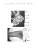 Composites for Osteosynthesis diagram and image