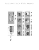 Compositions for Diagnosis and Therapy of Diseases Associated with     Aberrant Expression of Futrins (R-Spondins) and/or Wnt diagram and image