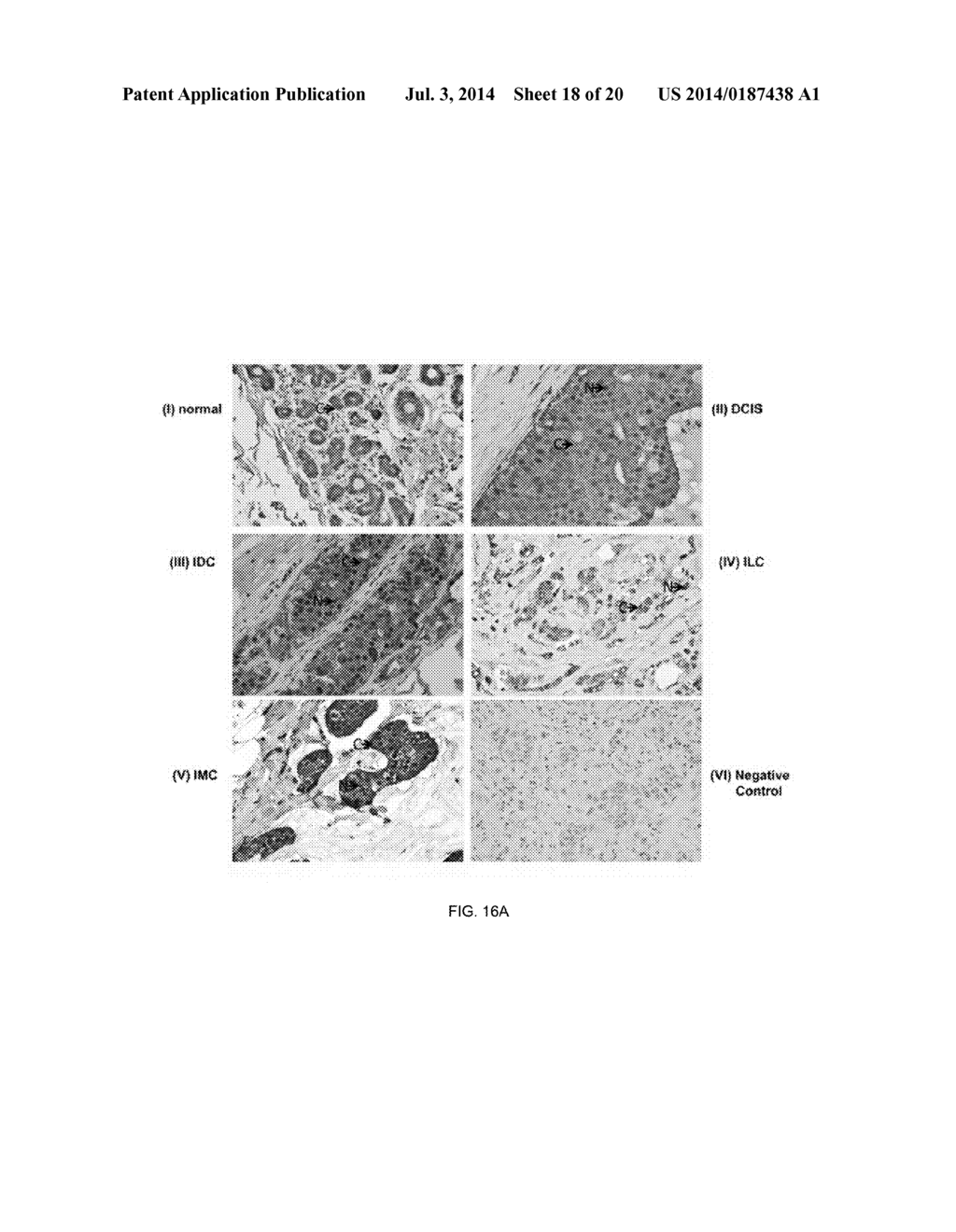 Methods and Compositions for the Diagnosis and Treatment of Epithelial     Cancers - diagram, schematic, and image 19