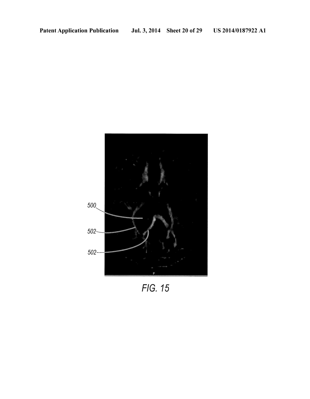 SURGICAL ACCESS SYSTEM WITH NAVIGATION ELEMENT AND METHOD OF USING SAME - diagram, schematic, and image 21