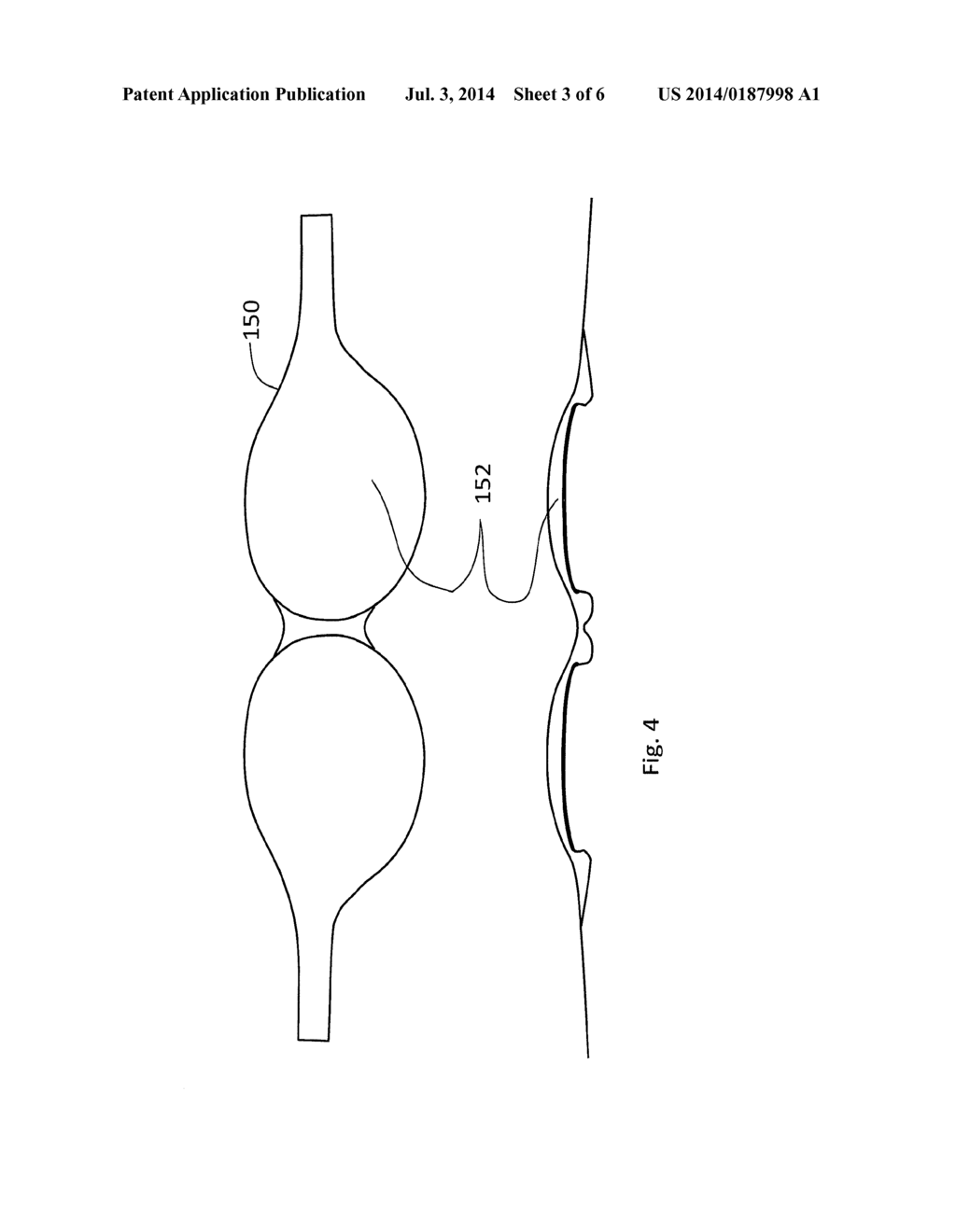 DEVICES AND TREATMENT METHODS FOR VASCULAR EYE DISEASES - diagram, schematic, and image 04