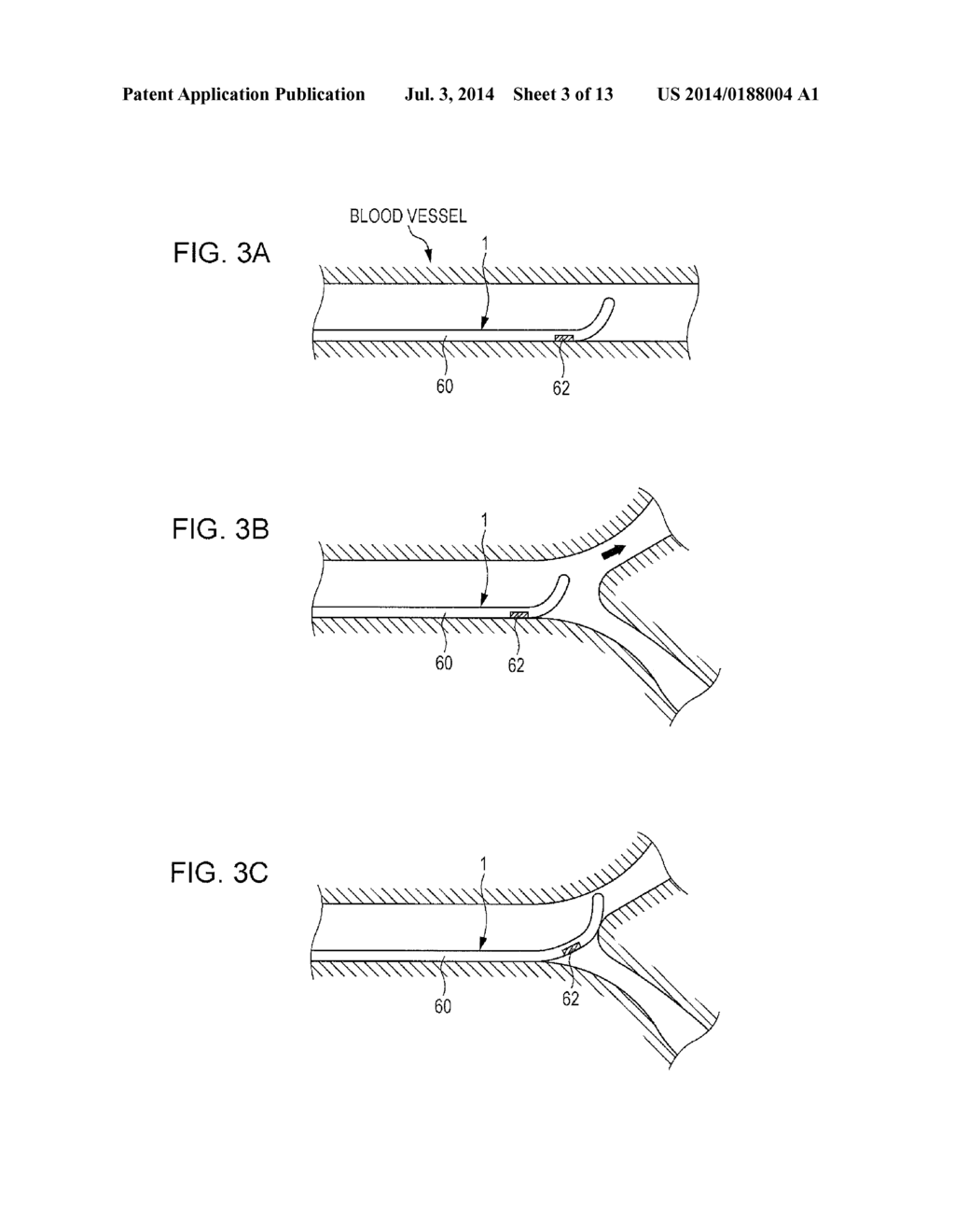 GUIDEWIRE - diagram, schematic, and image 04