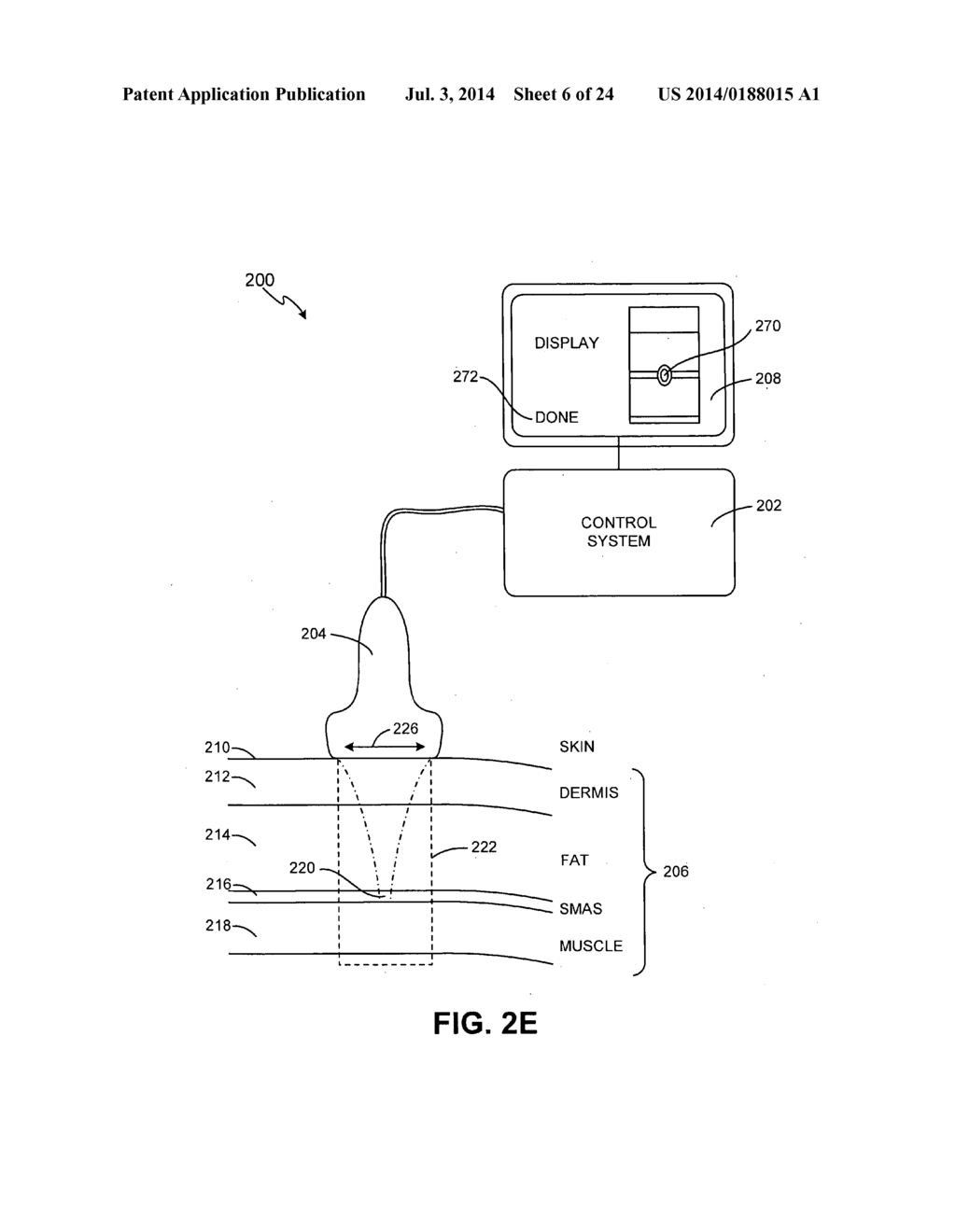 ENERGY-BASED TISSUE TIGHTENING SYSTEM - diagram, schematic, and image 07