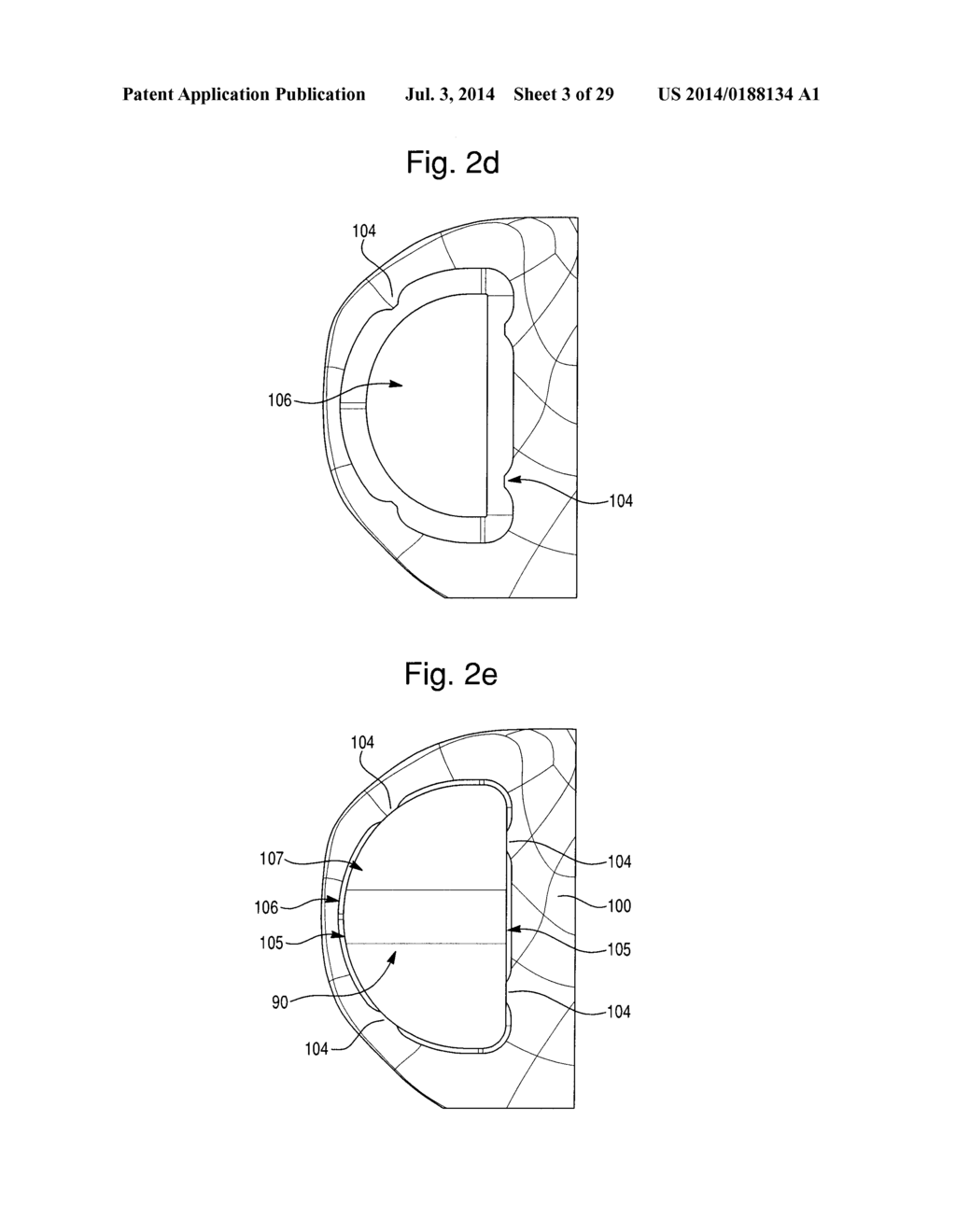 PROSTHETIC DEVICE, METHOD OF PLANNING BONE REMOVAL FOR IMPLANTATION OF     PROSTHETIC DEVICE, AND ROBOTIC SYSTEM - diagram, schematic, and image 04