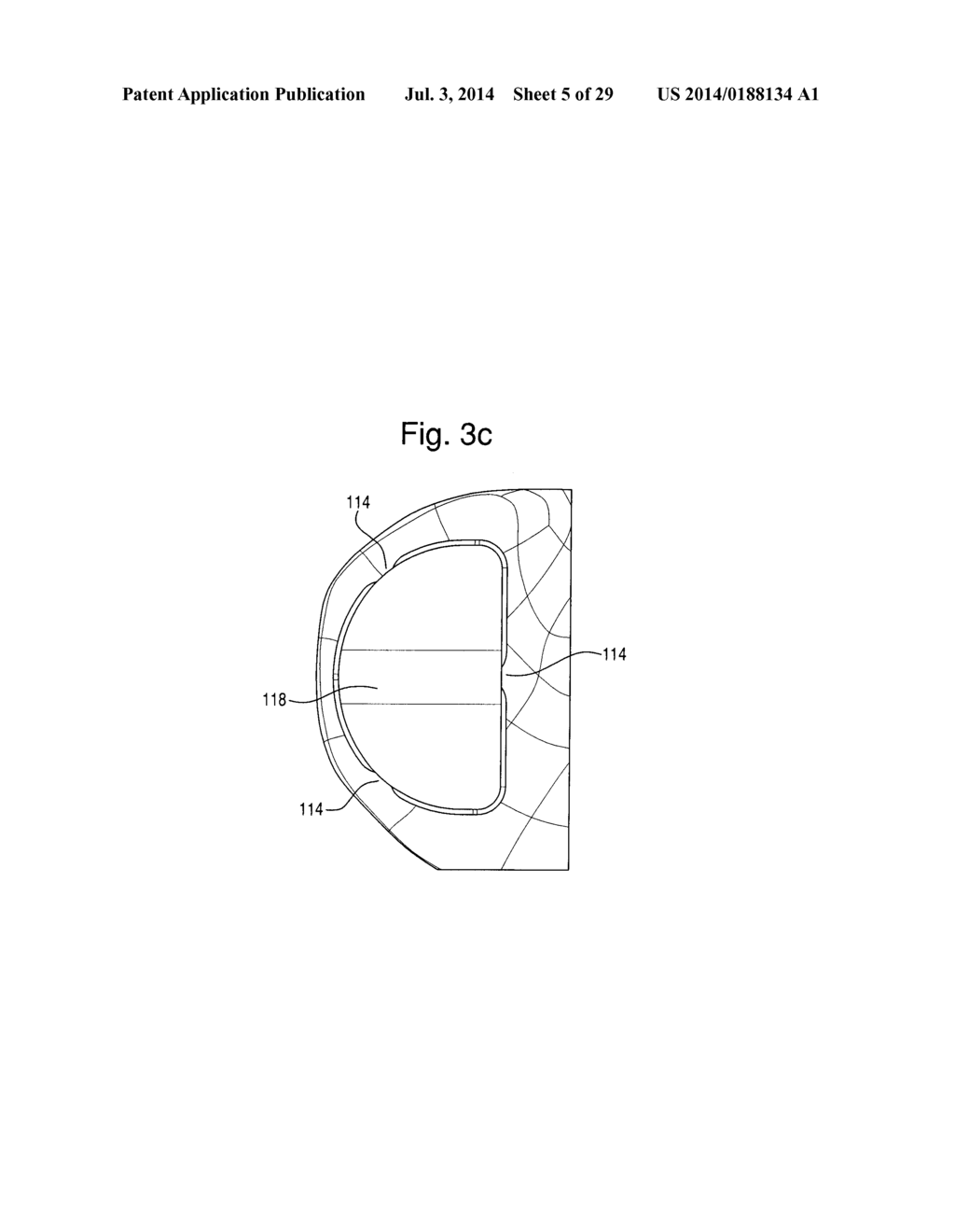 PROSTHETIC DEVICE, METHOD OF PLANNING BONE REMOVAL FOR IMPLANTATION OF     PROSTHETIC DEVICE, AND ROBOTIC SYSTEM - diagram, schematic, and image 06