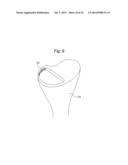 PROSTHETIC DEVICE, METHOD OF PLANNING BONE REMOVAL FOR IMPLANTATION OF     PROSTHETIC DEVICE, AND ROBOTIC SYSTEM diagram and image