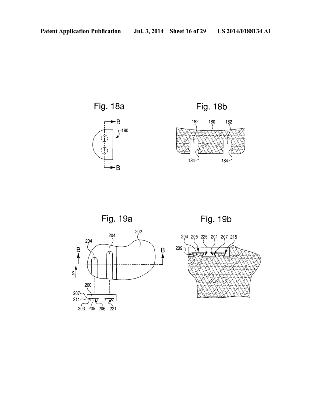 PROSTHETIC DEVICE, METHOD OF PLANNING BONE REMOVAL FOR IMPLANTATION OF     PROSTHETIC DEVICE, AND ROBOTIC SYSTEM - diagram, schematic, and image 17