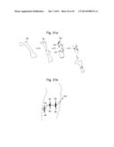 PROSTHETIC DEVICE, METHOD OF PLANNING BONE REMOVAL FOR IMPLANTATION OF     PROSTHETIC DEVICE, AND ROBOTIC SYSTEM diagram and image
