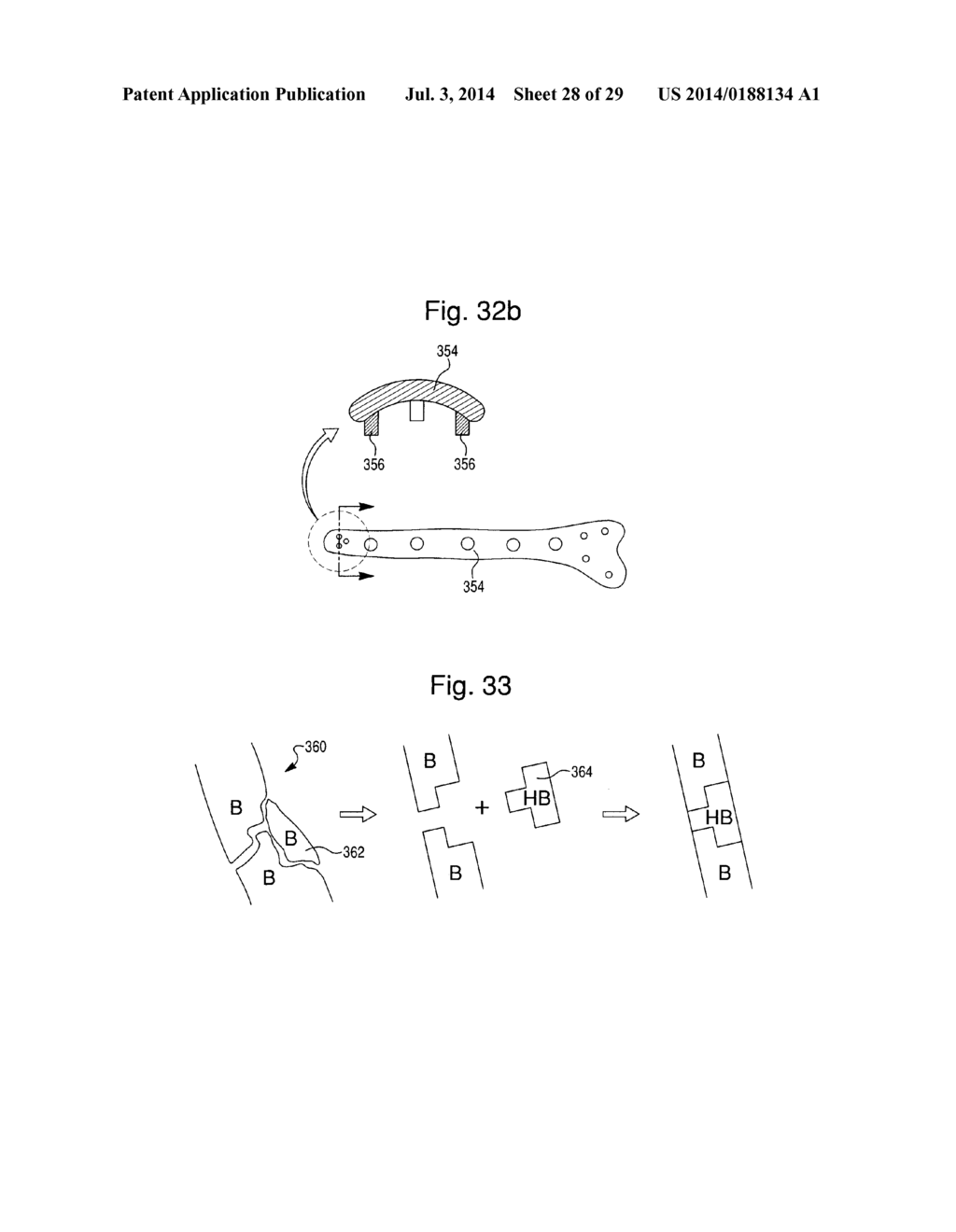 PROSTHETIC DEVICE, METHOD OF PLANNING BONE REMOVAL FOR IMPLANTATION OF     PROSTHETIC DEVICE, AND ROBOTIC SYSTEM - diagram, schematic, and image 29