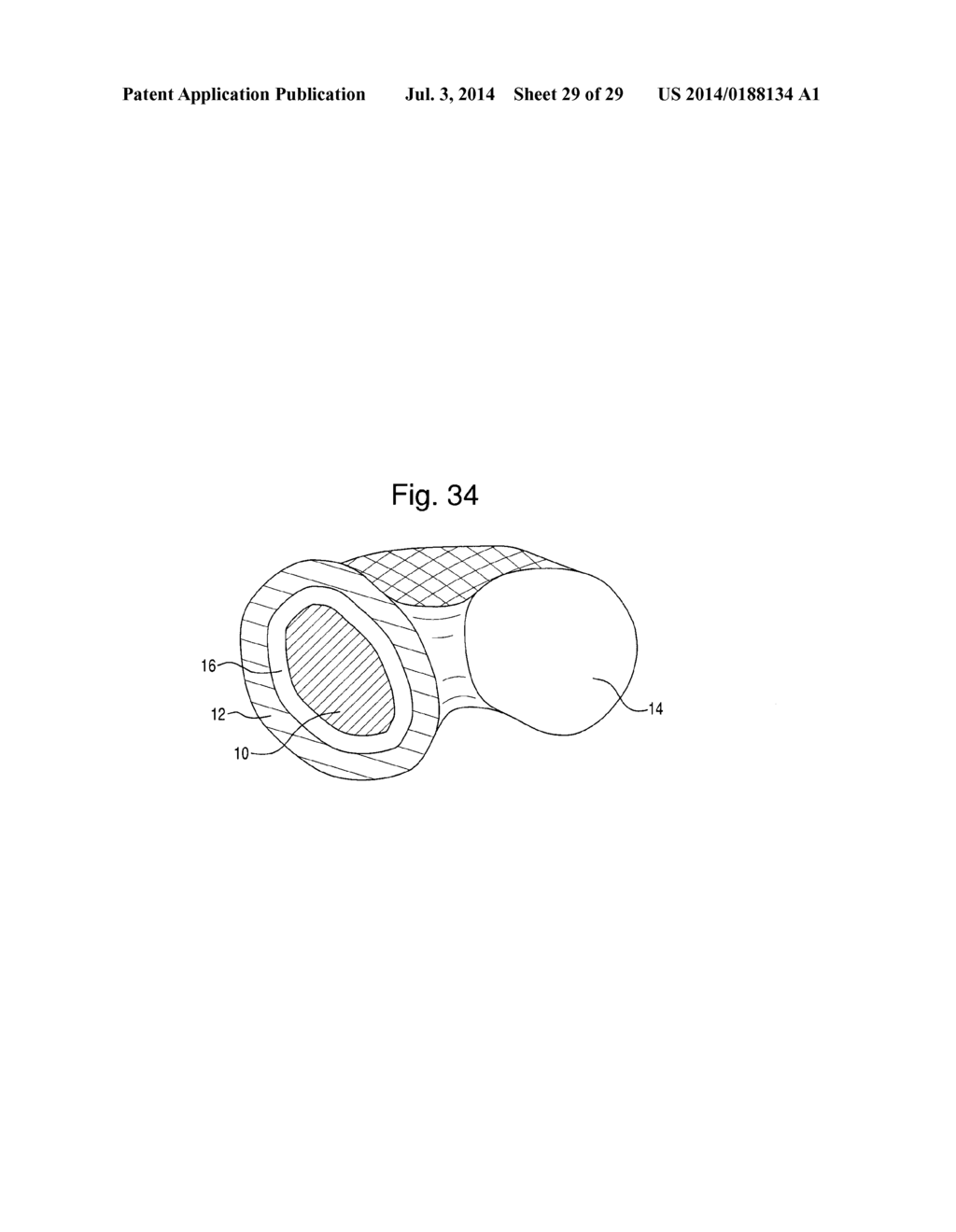 PROSTHETIC DEVICE, METHOD OF PLANNING BONE REMOVAL FOR IMPLANTATION OF     PROSTHETIC DEVICE, AND ROBOTIC SYSTEM - diagram, schematic, and image 30