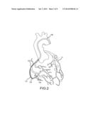 STEERABLE ULTRASOUND CATHETER diagram and image