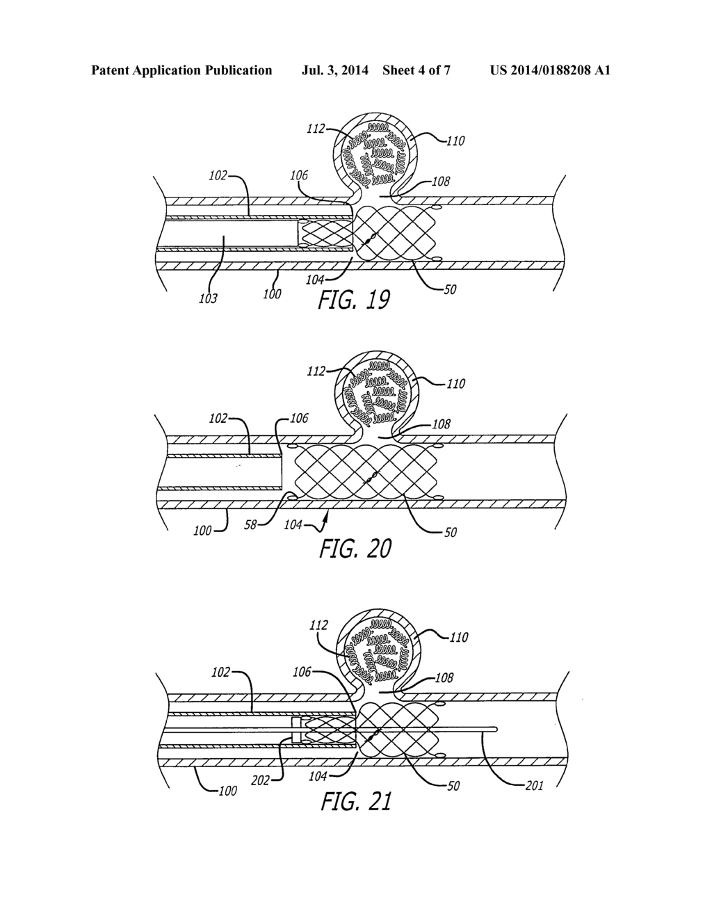 SELF-EXPANDING PSEUDO-BRAIDED INTRAVASCULAR DEVICE - diagram, schematic, and image 05