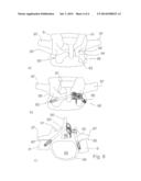 REINFORCEMENT IMPLANT FOR LAMINA WITH A CANTILEVER BRIDGE PART diagram and image