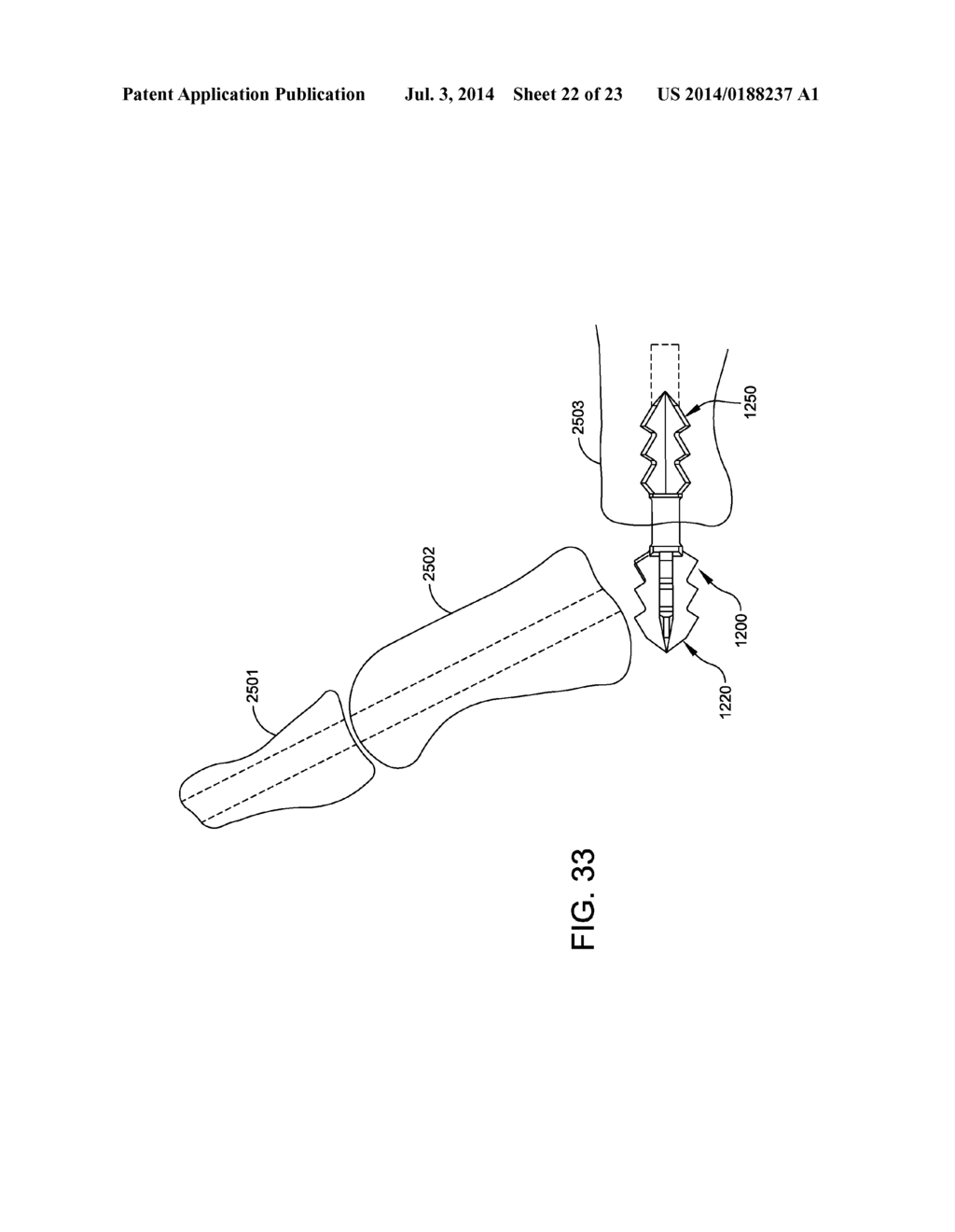 DEVICE AND METHOD FOR FIXATION FOR BONE OR SOFT TISSUE DEFORMITY OF DIGITS - diagram, schematic, and image 23