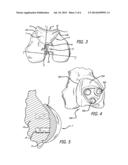 MARKING TEMPLATE FOR INSTALLING A CUSTOM REPLACEMENT DEVICE FOR     RESURFACING A FEMUR AND ASSOCIATED INSTALLATION METHOD diagram and image