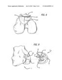 MARKING TEMPLATE FOR INSTALLING A CUSTOM REPLACEMENT DEVICE FOR     RESURFACING A FEMUR AND ASSOCIATED INSTALLATION METHOD diagram and image