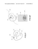 Detachable Clamping Sinker With Water Soluble Detachment diagram and image