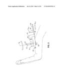 TREATMENT OF CARPAL TUNNEL SYNDROME BY INJECTION OF THE FLEXOR RETINACULUM diagram and image