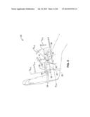 TREATMENT OF CARPAL TUNNEL SYNDROME BY INJECTION OF THE FLEXOR RETINACULUM diagram and image