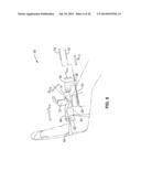 TREATMENT OF CARPAL TUNNEL SYNDROME BY INJECTION OF THE FLEXOR RETINACULUM diagram and image